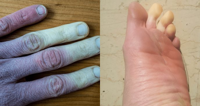 Así es la Enfermedad de Raynaud: el fenómeno de los "dedos blancos"