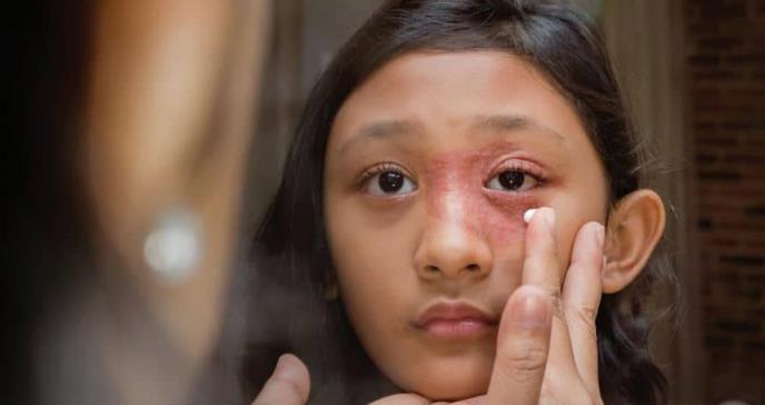 Subdiagnóstico de Dermatitis Atópica en niños puertorriqueños