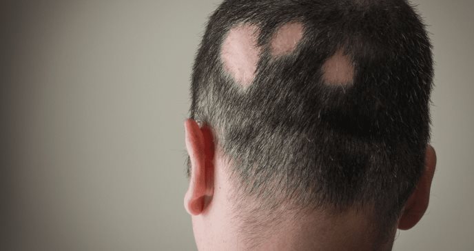 Ritlecitinib y brepocitinib mejoran biomarcadores de alopecia areata del cuero cabelludo, según estudio