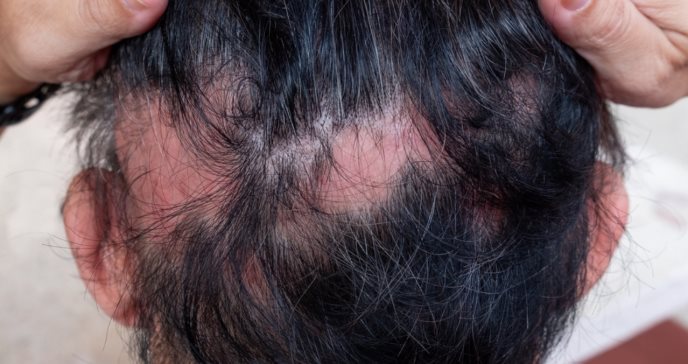La FDA aprobó Olumiant, tratamiento para adultos con alopecia areata grave