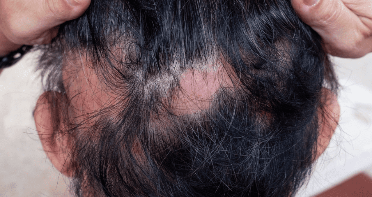La FDA Olumiant, tratamiento para adultos alopecia areata grave