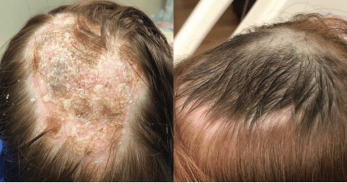 Revelan manifestación de alopecia psoriásica infrecuente a causa de inhibidores de necrosis tumoral