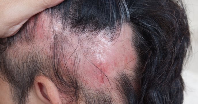 Caída de pelo por estrés: el impacto de la alopecia en Puerto Rico