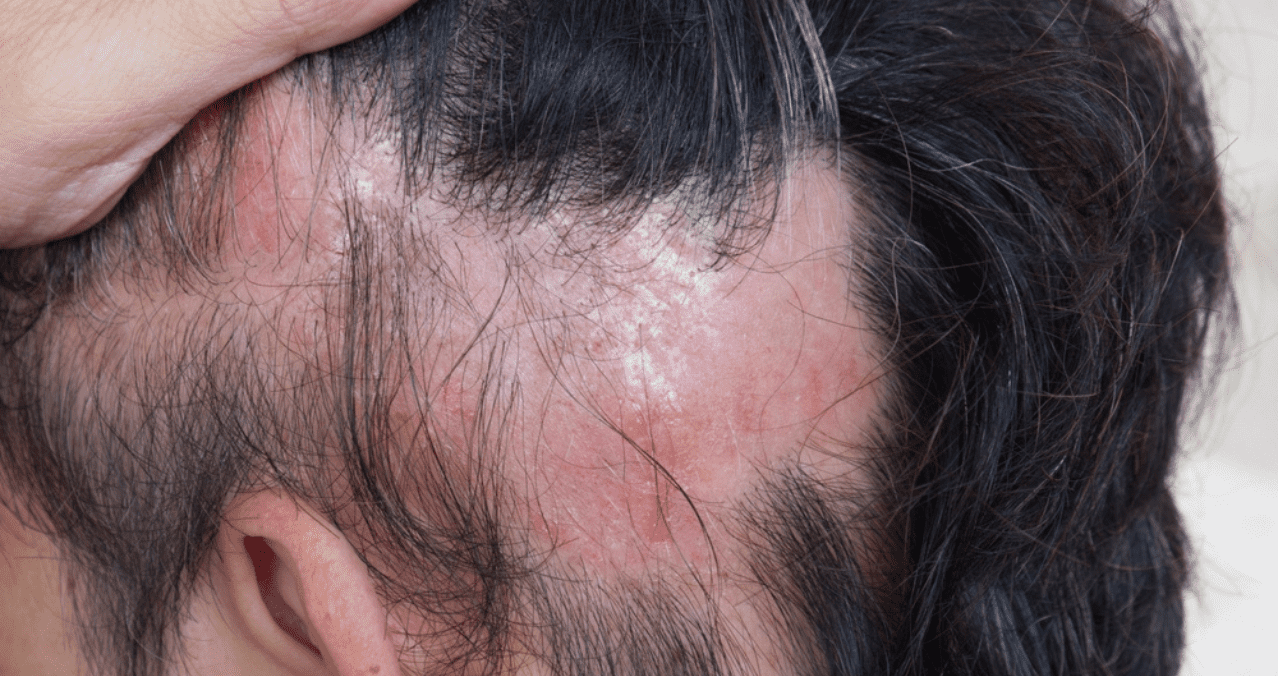 Caída de pelo el impacto de la alopecia Rico