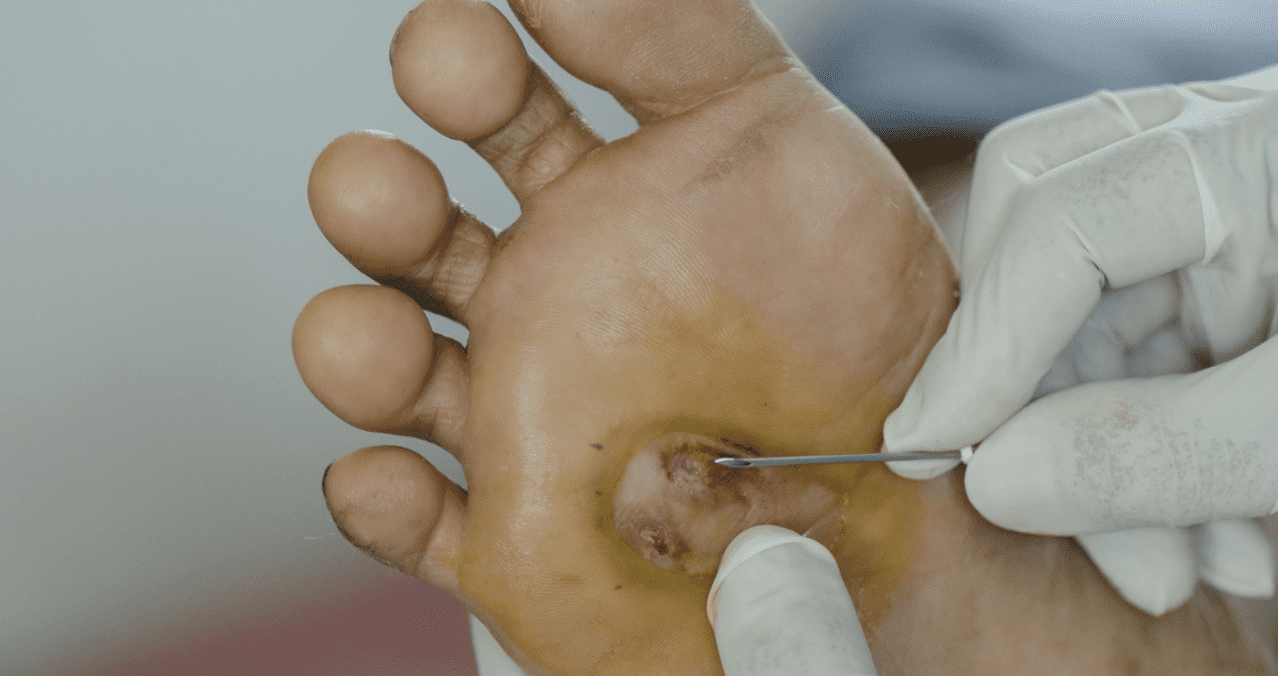 A new solution for the treatment of diabetic foot ulcers