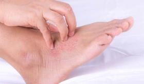 Psoriasis en las uñas, piel y articulaciones de los pies: Consejos para tratar y aliviar esta enfermedad