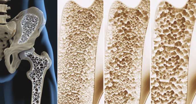 ¿Qué es la osteoporosis y por qué es cada vez más frecuente?