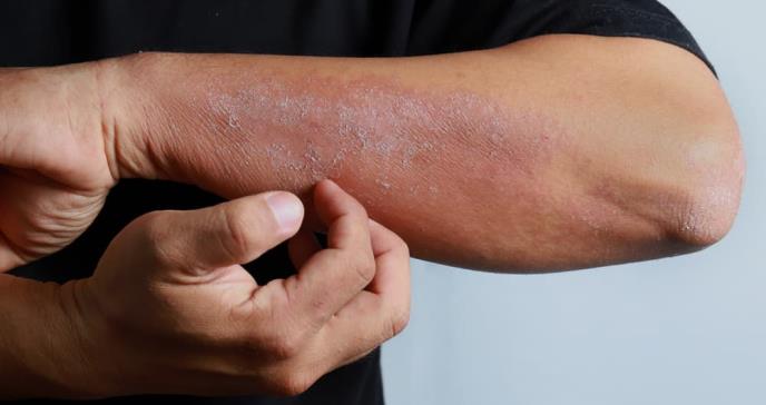 Las erupciones en la piel como síntoma temprano del Virus de Inmunodeficiencia Humana (VIH)