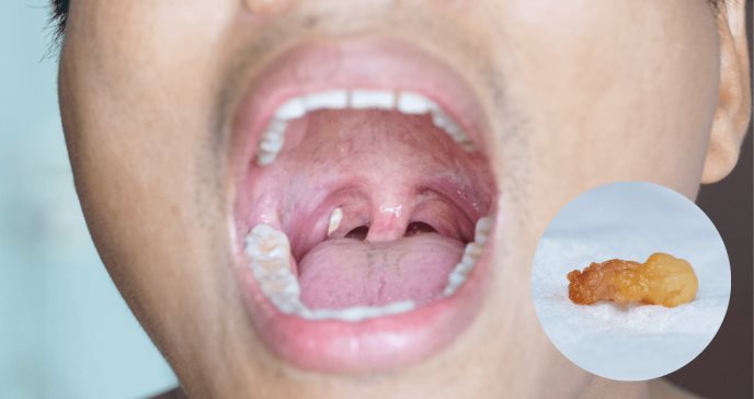 Tonsilolitos o piedras en las amígdalas: causas y tratamientos