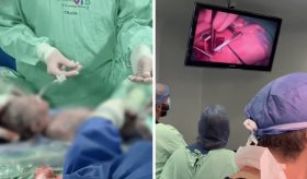 Latinoamérica: realizan primera cirugía cardiaca exitosa a bebé aún en la placenta de su madre