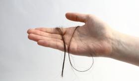 Así es la Tricotilomanía: el trastorno donde existe un impulso irresistible de arrancarse el cabello