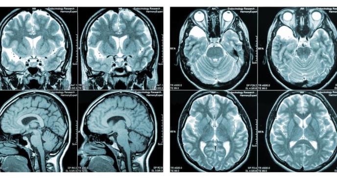 Abordaje del dolor neuropático asociado a Esclerosis Múltiple