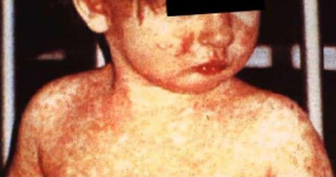 Niños no vacunados en Ohio presentan el primer cuadro de brote de sarampión en Estados Unidos