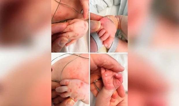 Se registra primer caso de viruela de mono en un bebé recién nacido