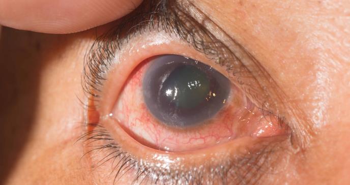 Glaucoma, retinopatía diabética, cataratas y otras afecciones oculares derivadas de la diabetes