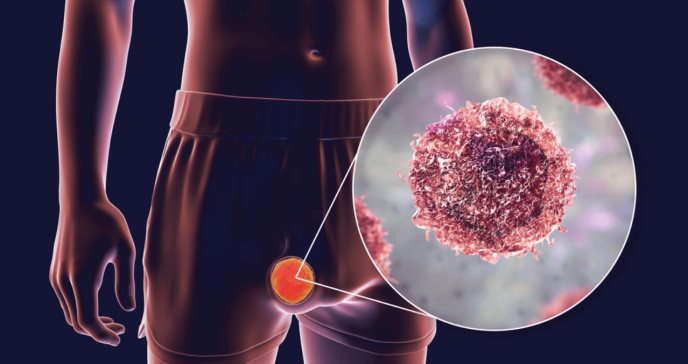 Reconozca los síntomas del cáncer testicular que pueden pasar inadvertidos
