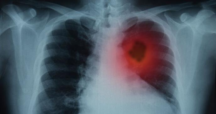 Revelan actualización de los factores de riesgo del cáncer de pulmón en personas no fumadoras