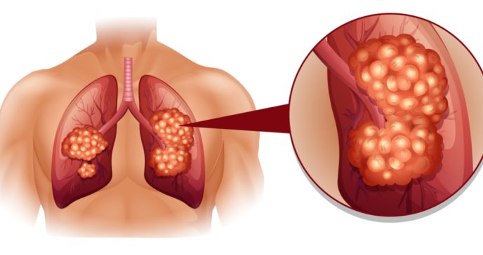 Reconozca los principales síntomas para la detección y tratamiento del cáncer de pulmón