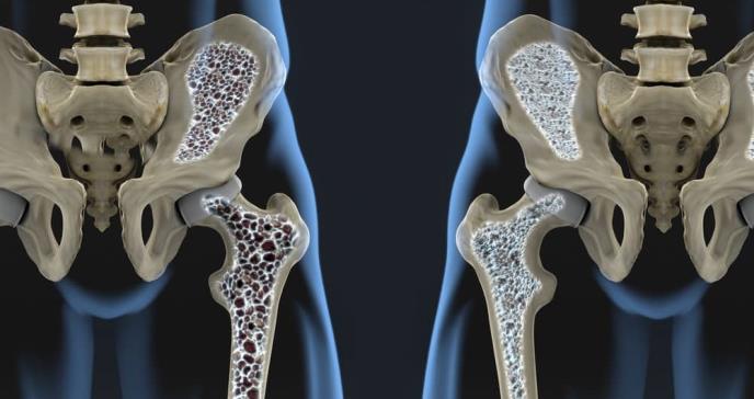 Es posible revertir el deterioro de los huesos, según un modelo experimental 