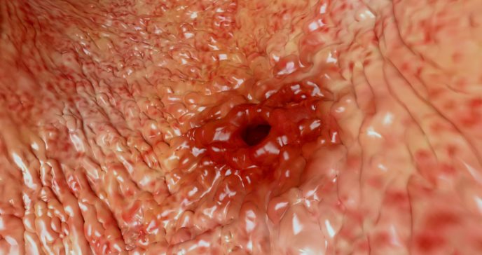 Úlcera del estómago: ¿cómo se cura?