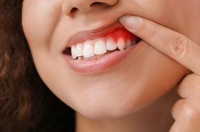Pobre higiene dental y enfermedades de las encías como gingivitis aumentan riesgo de cáncer pancreático