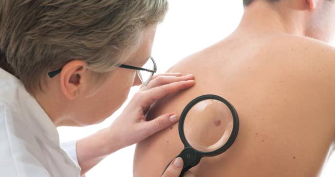 El melanoma no es el único cáncer de piel grave