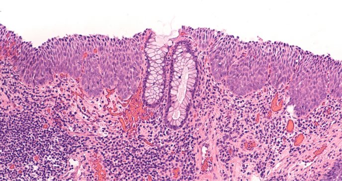 Prevención de lesiones intraepiteliales de alto grado reduce riesgo de cáncer anal causado por VPH