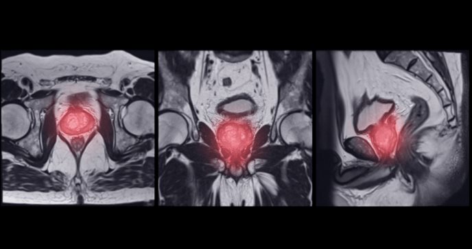 Uso de biomarcadores podría evitar biopsias en el diagnóstico de cáncer de próstata, indica estudio