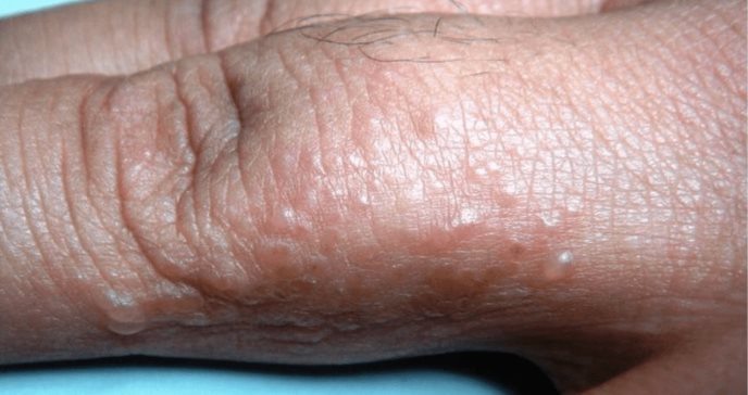 Dishidrosis o eczema dishidrótico: las ampollas que aparecen en la piel sin causa conocida