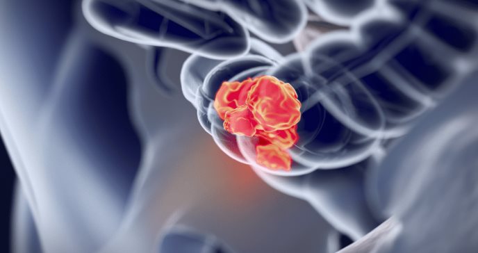 La importancia de revisar las heces y detectar los síntomas tempranos del cáncer de colon
