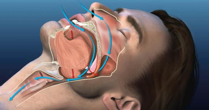 La apnea obstructiva del sueño aumenta el riesgo de pérdida auditiva