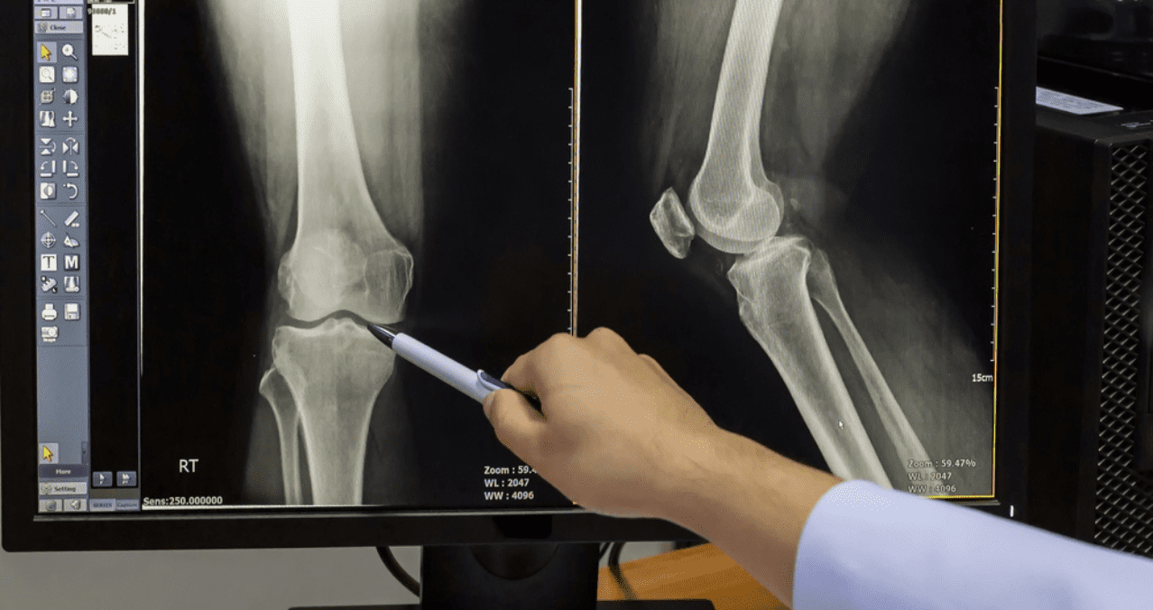 Radiografía de osteoartritis de la rodilla