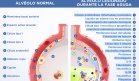 Diferencias entre un alvéolo normal y lesionado - Infografía