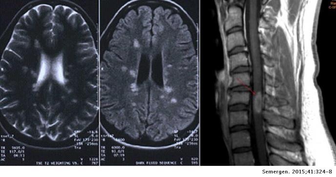 Revisión de la esclerosis múltiple - diagnóstico y tratamiento