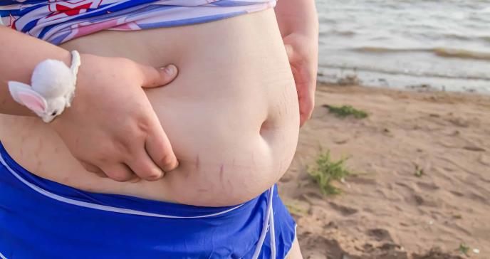 Obesidad infantil: causa de enfermedad de cadera en la adultez