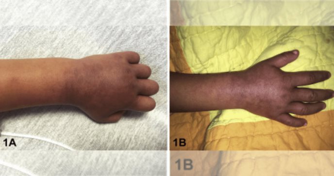 Paciente pediátrico presenta síndrome papular purpúrico de guantes y calcetín
