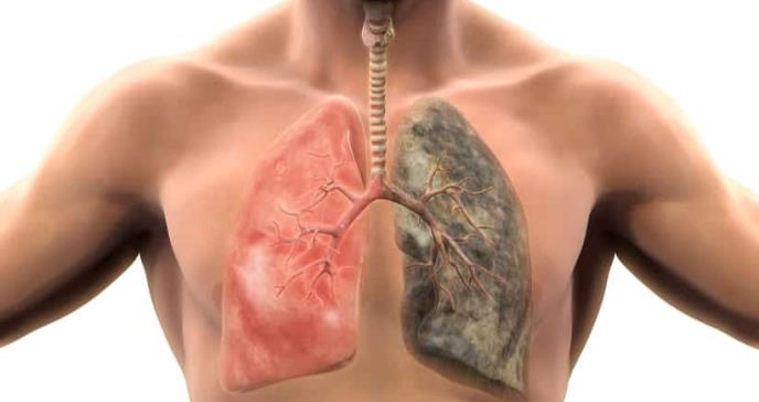 Tratamiento del cáncer de pulmón microcítico