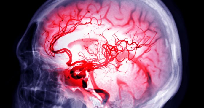 7 síntomas que le ayudarán a identificar derrames cerebrales