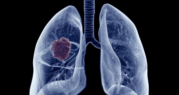 Encuentran una proteína que evita la metástasis del cáncer de pulmón