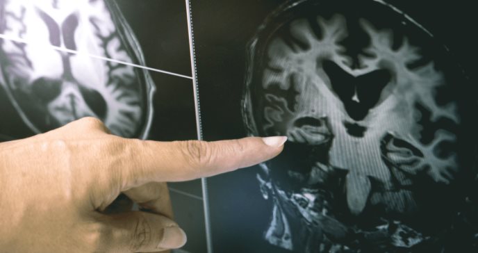 Neurólogos salvan la vida a mujer que sufrió accidente cerebrovascular