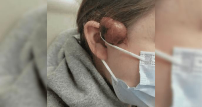 Fascitis nodular: reportan masa en el rostro de una adolescente