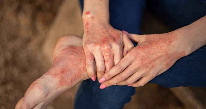 Nuevas pautas para el tratamiento de la dermatitis atópica en adultos