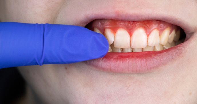 Estudio explica la relación bidireccional entre diabetes y periodontitis