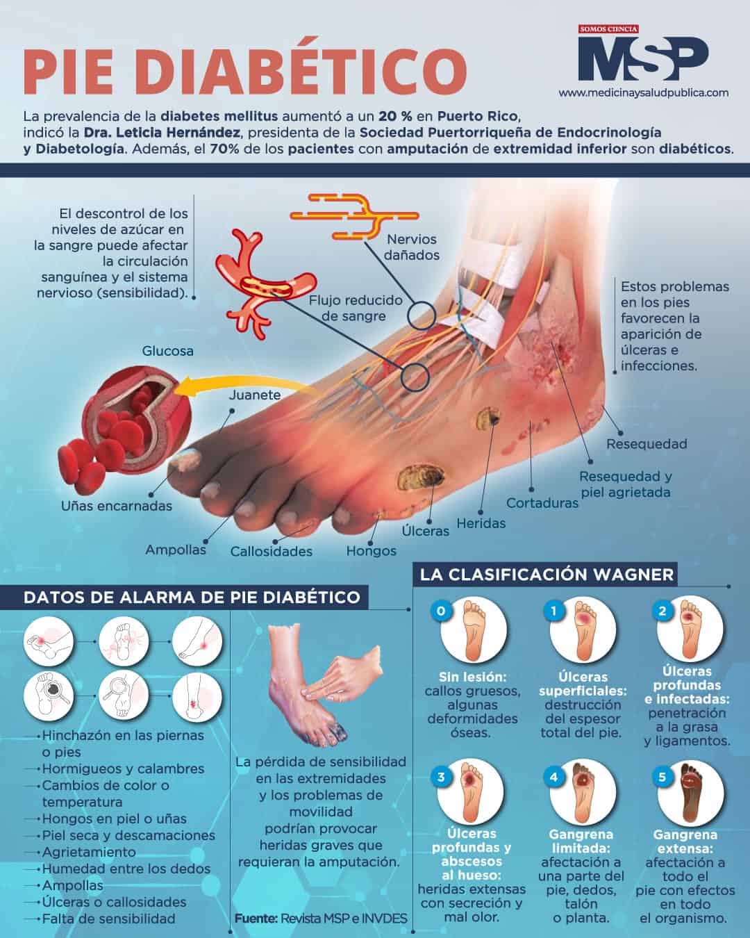 Pie Diabético Infografía 3984