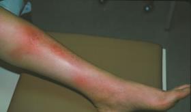 Eritema nudoso: los dolorosos hematomas que aparecen en las piernas