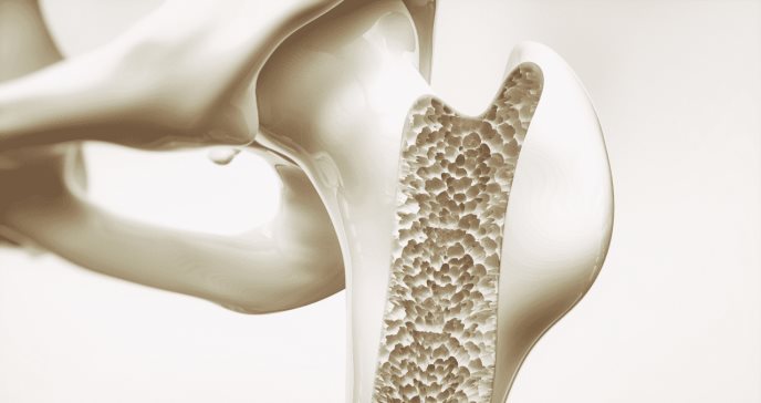 Recomendaciones para el tratamiento inicial de la osteoporosis en hombres y mujeres posmenopáusicas