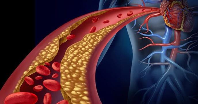 El colesterol HDL o bueno, no siempre beneficia a la salud del corazón