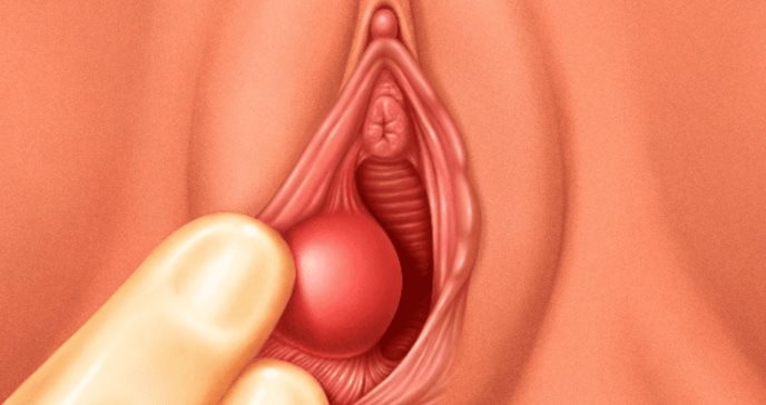 Bartolinitis o quistes de Bartolino: lo que sucede cuando las glándulas vaginales se obstruyen