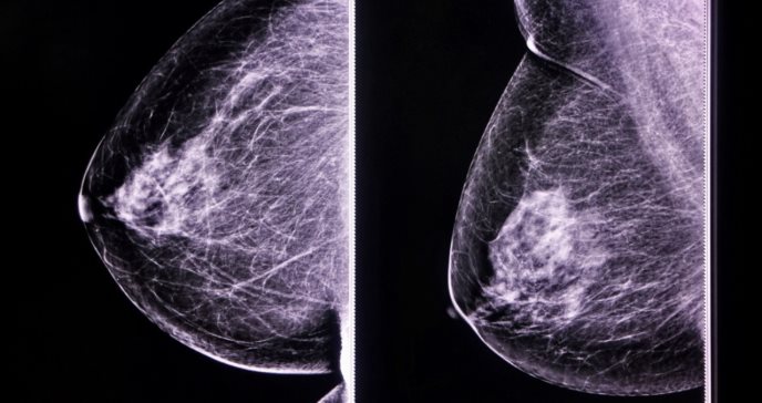 Cáncer de seno: mamografía de contraste, ideal para detección y seguimiento