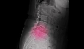 Espondilolistesis y desplazamiento de vértebras: del dolor de espalda a la intervención quirúrgica